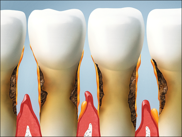 5 Common Gum Disease Myths & Facts